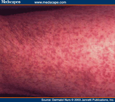 Unmasking Mastocytosis - Page 2