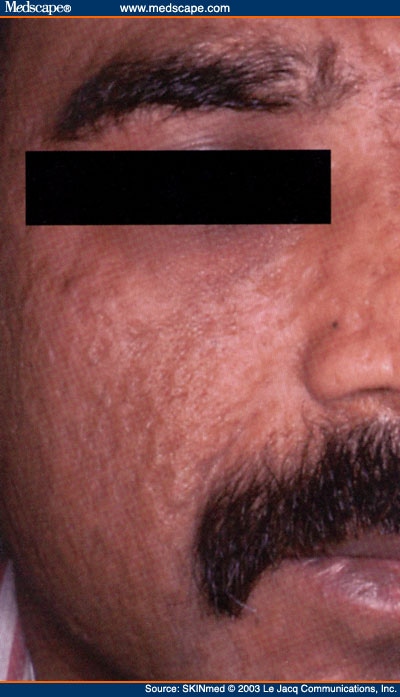 Cutaneous Morphology: The Basic Tool of Dermatology