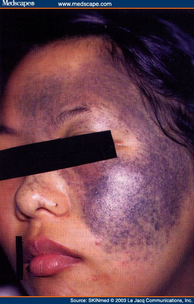 Nevus of Ota: Clinical Aspects and Management - Page 4