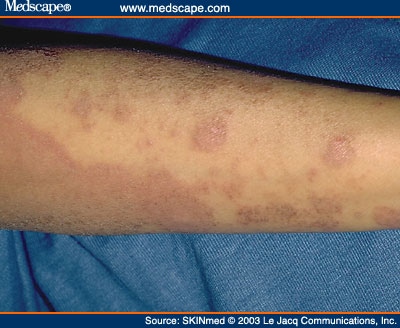 Atopic Dermatitis