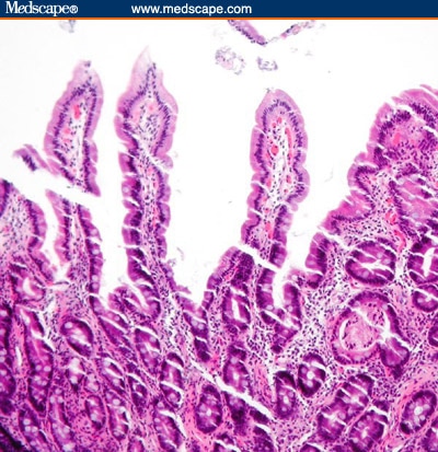 An AIDS Patient With PCP and New-Onset Ascites - Page 3