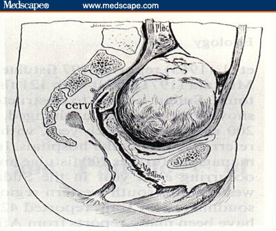 Obstructed Labor and the Vesico-Vaginal Fistula - Page 4