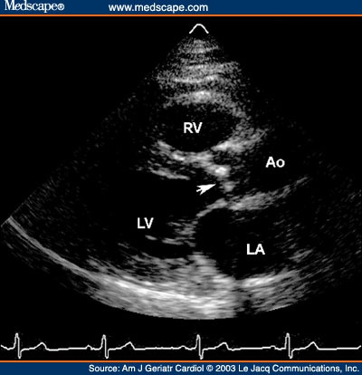 Calcific Aortic Stenosis in the Elderly: A Brief Overview - Page 3