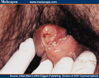 thrush penis head Male nude pixs