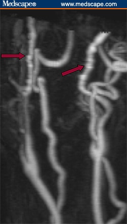 Krinsky's Case Challenge, Case Xix: Carotid Bruit