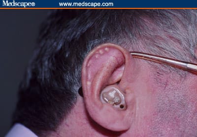 White Papules on the Ear