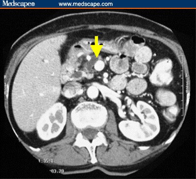 Unusual Finding in Pancreas Divisum and Abdominal Pain