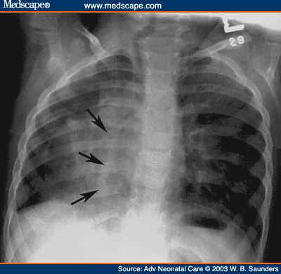 A Case Series Of Five Infants With Scimitar Syndrome - Page 2