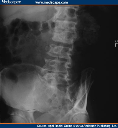 Abdominal Distention