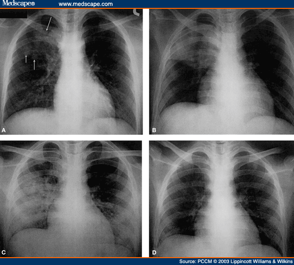 Severe Acute Respiratory Syndrome in Children - Page 3