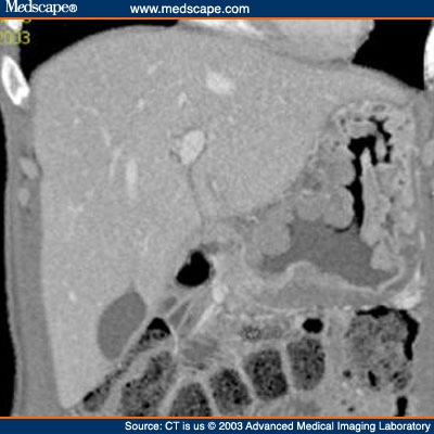 GIST Tumor or Metastatic Disease