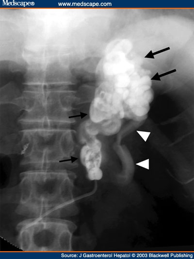 Balloon-Occluded Retrograde Transvenous Obliteration Improves - Page 2