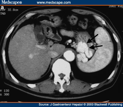 Balloon-Occluded Retrograde Transvenous Obliteration Improves