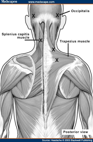 Procedures for Administering Botulinum Toxin Type A