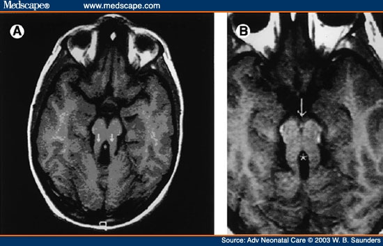 Joubert syndrome что это