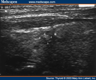 Ultrasound-Guided Laser Thermal Ablation and Goiter - Page 3