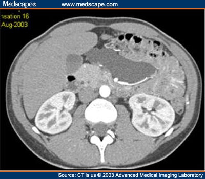 hematoma lipoma