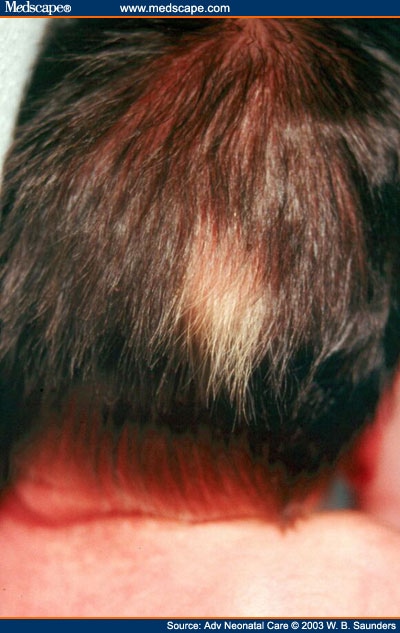 Scalp Hair Characteristics In The Newborn Infant