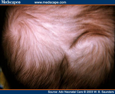 whorls whorl abnormal scalp indicate