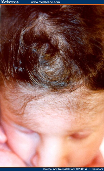 Scalp Hair Characteristics in the Newborn Infant