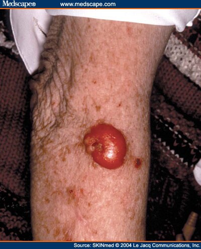 Keratoacanthoma