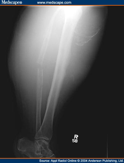 Right Leg Pain After Recent Fall