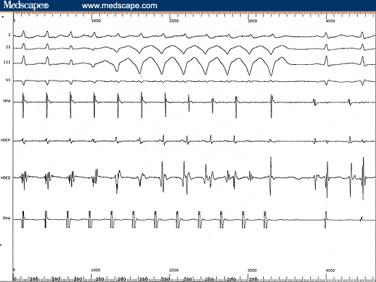 Electrophysiology Lab Consult Case 3