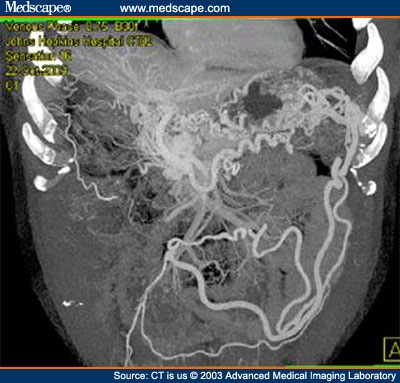 Cirrhosis Or Pancreatic Cancer