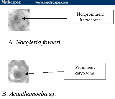 naegleria fowleri meningoencephalitis amoebic amoeba photomicrograph