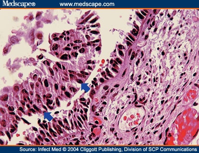 Schistosomiasis in Two Patients With Painless Hematuria