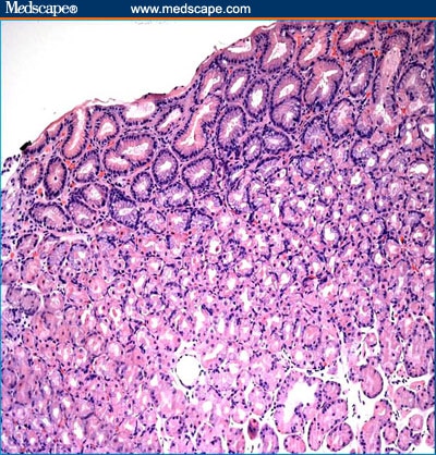 A 42-Year-Old Cushingoid Man With a Bleeding Duodenal Ulcer