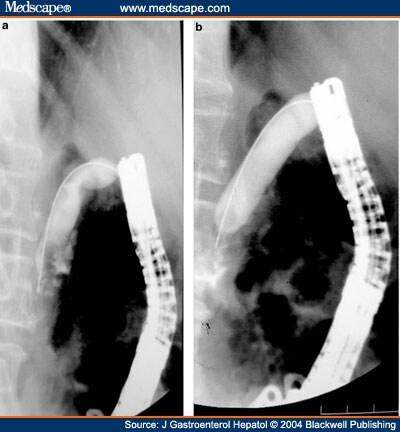 Endoscopic Balloon Dilatation Of Benign Gastric Outlet - Page 2