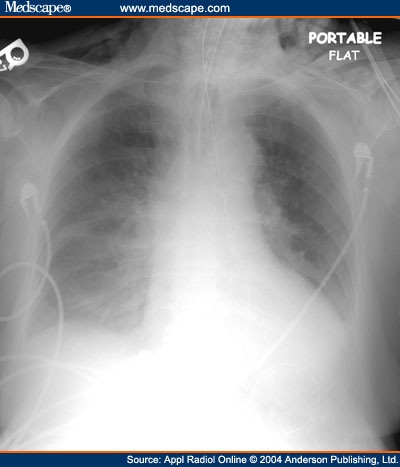 Emergent Intubation After Myocardial Infarction