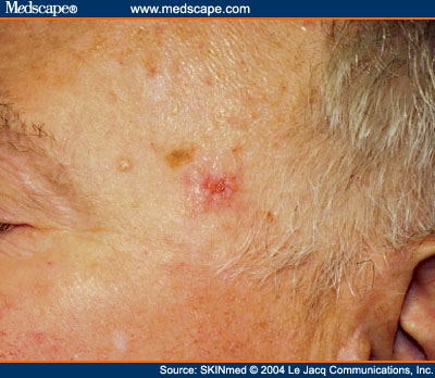 Merkel Cell Carcinoma of the Left Temple