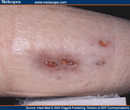 Cutaneous Aspergillosis