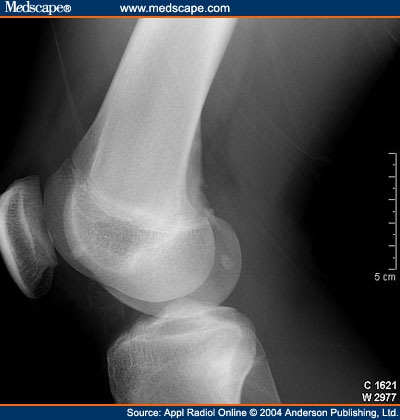 15 Year Old With Knee Trauma