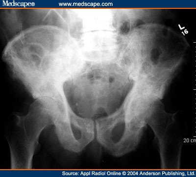 83 Year Old Male With History of Hepatocellular Carcinoma