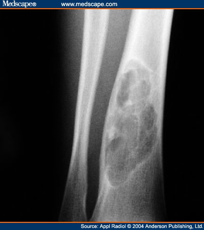 General Approach to Lytic Bone Lesions