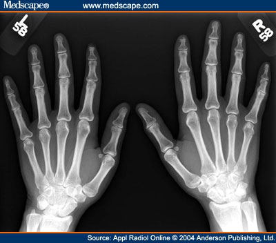 History of Raynaud's syndrome