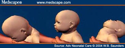 Preventing Shaken Baby Syndrome