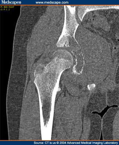 Osteomyelitis or Osteosarcoma?