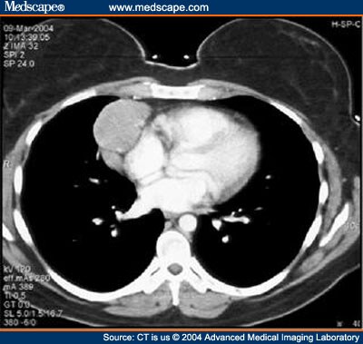 Possible Castleman's Disease