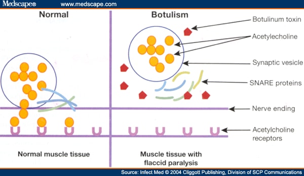 how to get botulinum toxin