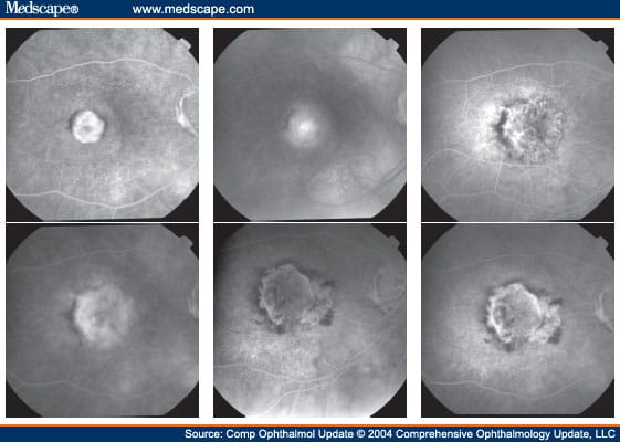 Neovascular Age-Related Macular Degeneration - Page 3