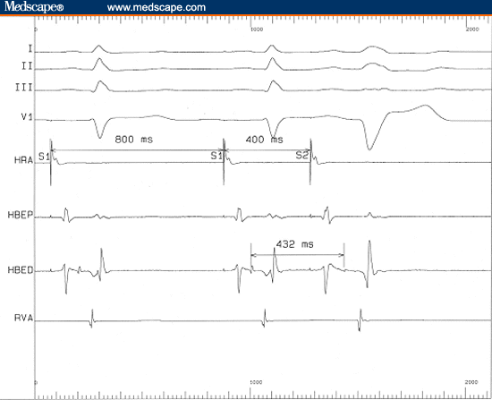 Electrophysiology Lab Consult Case 4