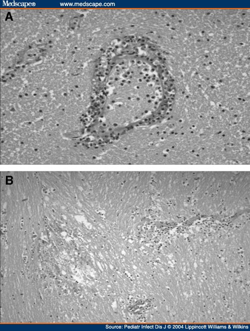 Acute Disseminated Encephalomyelitis In Childhood