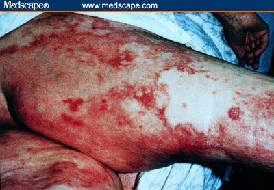 Etiology and Pathogenesis of Necrolytic Migratory Erythema