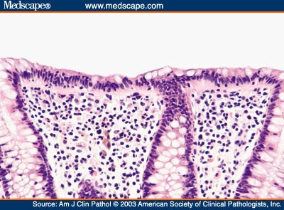 Paucicellular and Asymptomatic Lymphocytic Colitis