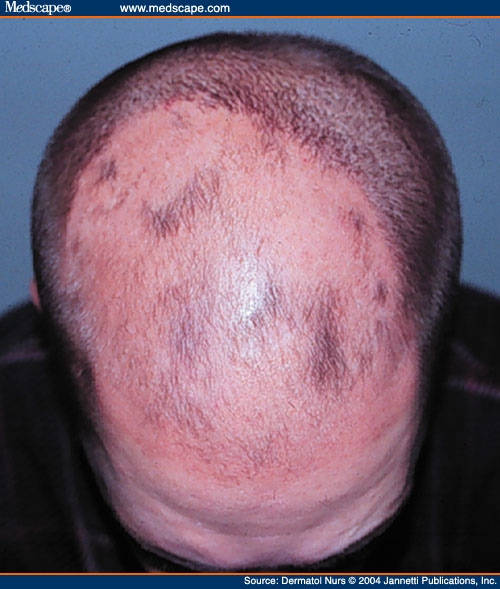 Topical Sensitizers in Alopecia Areata