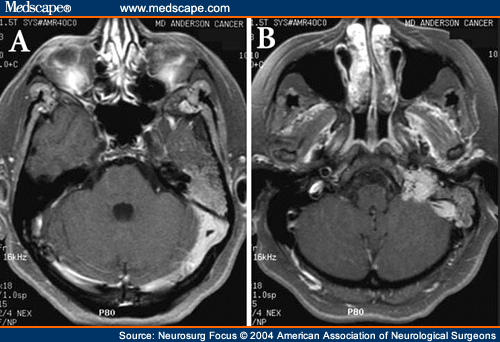 Complete Resection of a Complex Glomus Jugulare Tumor